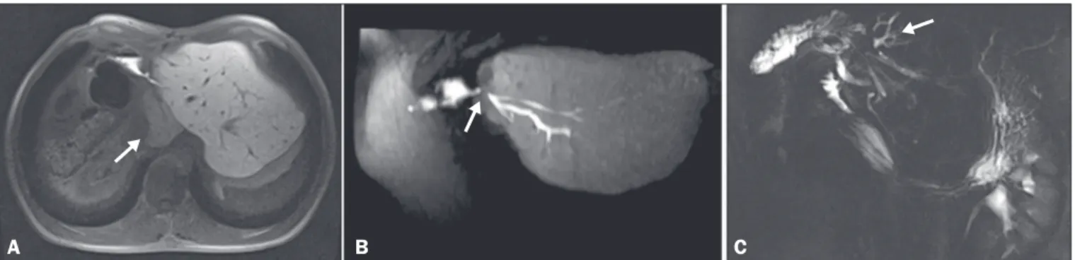Figure 7.  HSCA-enhanced coro - -nal T1-weighted MRC sequence  acquired  in  the  late  phase  ( A )  showing  that,  despite  moder  -ate dilation of the biliary tract,  there  was  no  elimination  of  contrast  in  the  hepatobiliary  phase,  due  to  o