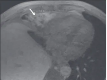 Figure 10.  Collection adjacent to the hepatectomy site, which ills with contrast  medium in the hepatobiliary phase of HSCA excretion, conirming the diagnosis  of biloma (arrow).