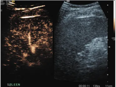 Figure 1. Zebra sign. A split-screen view. Striations are seen in a normally per- per-fused spleen in the early arterial phase, the CT analog of the zebra sign.