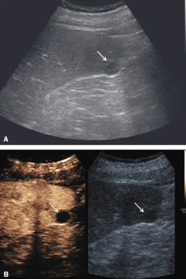 Figure 3. Abscess. A: Contrast-enhanced CT scan showing a hypodense splen- splic lesion with a thsplick, irregular wall (arrows)