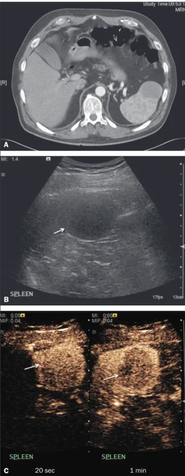 Figure 9. Hairy-cell leukemia. A: CT scan showing a rounded, hypodense soft- soft-tissue lesion (arrow)