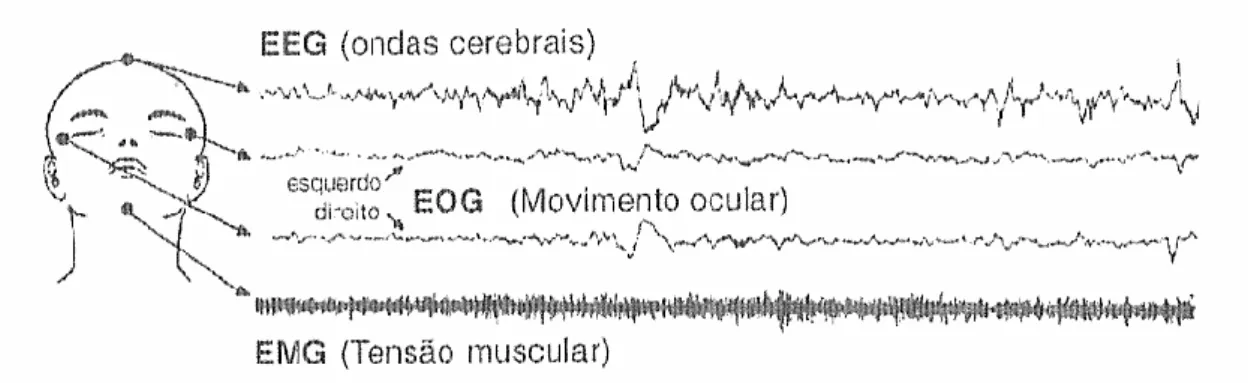 Figura 1. O sono é medido por três tipos de sinais fisiológicos através do EEG e do EOG e do EMG  (Morin, 2001)