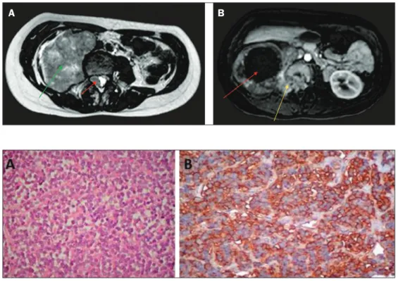 Figure 1. A: Axial T2-weighted MRI scan  showing a huge heterogeneous  retro-peritoneal mass (green arrow) with an  isointense intradural component (red  arrow)