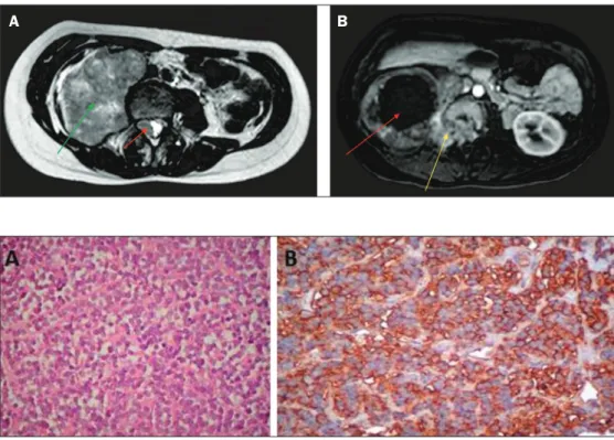 Figure 1. A: Axial T2-weighted MRI scan  showing  a  huge  heterogeneous   retro-peritoneal  mass  (green  arrow)  with  an  isointense intradural component (red  arrow)