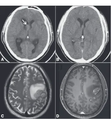Figure 1. A: Non-contrast-enhanced CT scan of the brain, showing well- well-delineated, discretely hyperdense intraventricular nodule to the right of the  foramen of Monro (arrow), promoting slight dilation of the lateral ventricles  (obstructive hydroceph