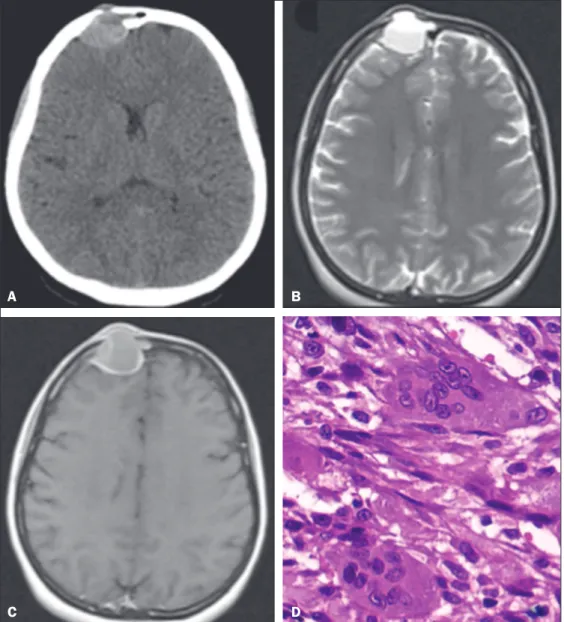 Figura 1. A: TC de crânio com contraste  intravenoso, corte axial, demonstrando  formação  expansiva  extra-axial  com  destruição  óssea  e  epicentro  no  seio  frontal direito, apresentando-se  espon-taneamente densa, com aparente nível  líquido e limit