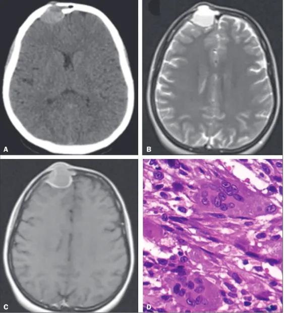 Figure 1. A: Axial CT of the skull, after  intravenous administration of contrast  material, showing a dense,  spontane-ous, expansile extra-axial formation,  measuring 3.1 × 2.5 × 2.9 cm, with  its epicenter in the right frontal sinus,  featuring bone des