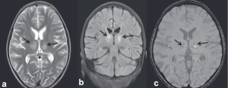 Figure 2.  9-year-old female with dengue encephalitis. Axial T2-weighted image ( a ) and coronal FLAIR image ( b ) showing a hyperintense signal in bilateral thalami  (arrows)