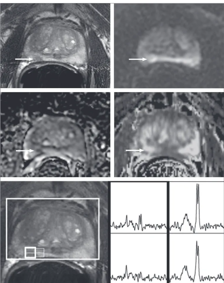 Figure 1.  73-year-old man with Gleason 4+3 prostate cancer in the right posterior peripheral zone on radical prostatectomy, corresponding to the indings on  imaging (arrows)