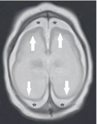 Figura 2. Paciente com 2 meses de idade. Ressonância magnética, T2, corte  axial demonstrando acentuada simpliicação do padrão giral pela presença de  agiria (setas)