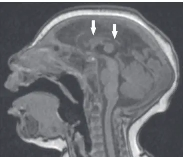 Figura 7. Paciente com 2 meses de idade. Ressonância magnética, T1 sem  contraste, corte sagital mostrando hipoplasia da ponte (seta), com perda da  convexidade habitual