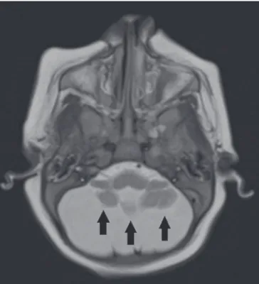 Figura 9. Paciente com 14 meses de idade. Ressonância magnética, T2, corte  sagital  demonstrando  ailamento  da  medula  dorsal  (setas)  em  criança  com  síndrome congênita pelo VZIK sem artrogripose