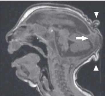 Figure 2. A 2-month-old patient. Axial T2-weighted MRI slice showing marked  simpliication of the gyral pattern, with agyria (arrows)
