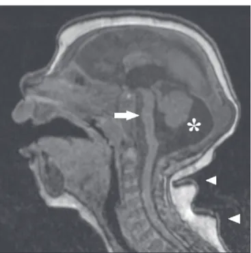 Figure 6.  A 3-month-old patient. Sagittal T1-weighted MRI slice, without con- con-trast, showing diffuse tapering of the corpus callosum (arrows)