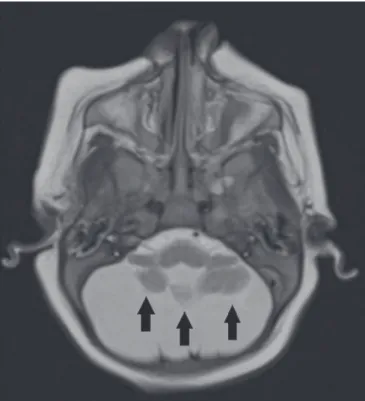 Figure 9.  A 14-month-old patient. Sagittal T1-weighted MRI slice showing ta- ta-pering of the dorsal medulla (arrows) in a congenital Zika syndrome patient  without arthrogryposis