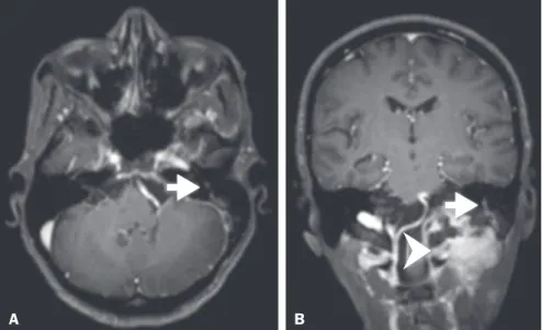Figure 9. T1-weighted MRI scan of a 59-year-old  male with (postoperative) squamous cell carcinoma  and cervical metastasis
