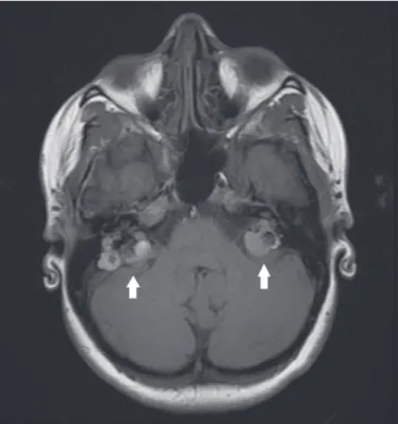 Figura 5.  Tumor do saco endolinfático. RM, sequência T1 sem contraste, corte  axial. Paciente com doença de von-Hippel-Lindau apresentando tumor de saco  endolinfático bilateral (setas).