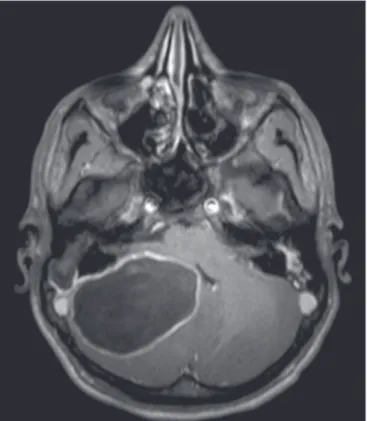 Figura 9.  Otomastoidite complicada com osteomielite. TC, janela óssea, corte  coronal demonstrando otomastoidite à direita associada a sequestro ósseo de  permeio (seta).