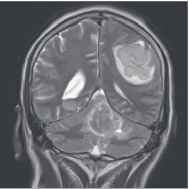 Figure 6. Metastasis. Coronal T2-weighted MRI sequence. Patient with breast  neoplasm presenting two lesions with perilesional edema.