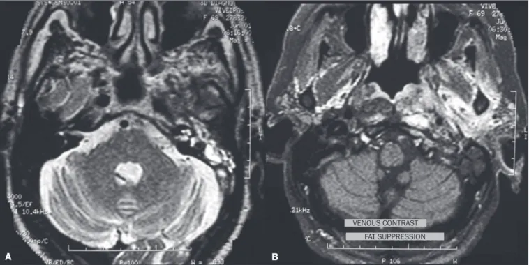 Figure 9. Osteomyelitis-complicated otomastoiditis. Coronal CT, with a bone  window, showing bone sequestration (arrow) within right-sided otomastoiditis.