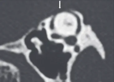 Figure 14. Superior semicircular canal dehiscence. CT with a bone window  and oblique reconstruction in the Pöschl plane, showing a bone defect in the  superior semicircular canal.
