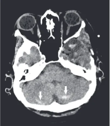 Figure 17. Remote cerebellar hemorrhage. Axial CT, with a parenchymal win- win-dow, showing dense foci with a striped aspect, affecting both cerebellar  hemi-spheres (arrows), consistent with bleeding, in a patient recently submitted to  neurosurgery.