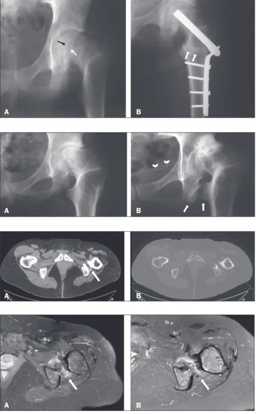 Figure 1. A: Initial radiograph of the left hip, in an  anteroposterior view, showing signs of  epiphysioly-sis, with inferomedial displacement of the femoral  head and an open physis (arrows)