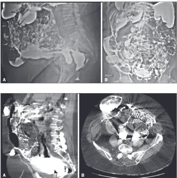 Figure 2. Computed tomography  scans of the abdomen, in the axial (A) 