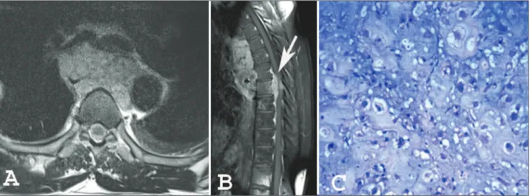 Figura 1. Ressonância magnética, imagens T2 axial (A) e T1 com contraste sagital (B) mostram lesão comprometendo o mediastino posterior e invadindo o canal  vertebral (seta em B)