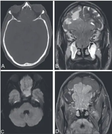 Figure 1. CT of the brain (A), with a bone window, showing an expansile lesion  occupying ethmoid cells and containing calcii cations, with bone destruction