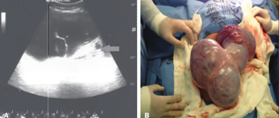 Figura 2. A: TC, corte axial sem con- con-traste intravenoso mostrando  ex-tensa formação sólido-cística, com  componente gorduroso, cálcico e  líquido