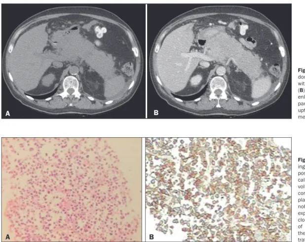 Figure 2. A: Histopathology show- show-ing malignant neoplasm  com-posed of loosely cohesive  atypi-cal cells, with hyperchromatic,  voluminous, eccentric nuclei,  consistent with a diagnosis of  plasma cell neoplasm