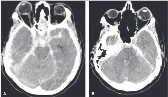 Figure 1. A: CT scan showing signs of  subarachnoid hemorrhage and right  intraocular hemorrhage, as a  sponta-neously hyperattenuating focus in the  posterior portion of the right globe