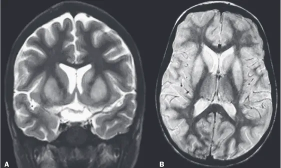 Figure 1. MRI of the brain showing  hyperintense lesions in the caudate  nuclei and putamen