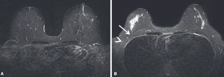 Figure 3. Chest wall. Heart and respiratory motion artifacts cause blurring and limit evaluation of the chest wall in routine axial Cartesian breast image of a  45-year-old woman with negative breast MRI (A)