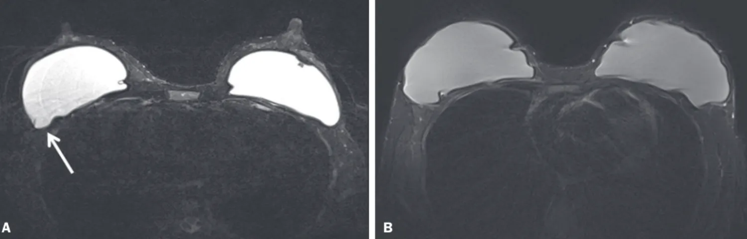 Figure 5. Effects of breast implants. Motion artifacts are observed adjacent to the implants and evident in the phase-encoding direction (arrow, A)