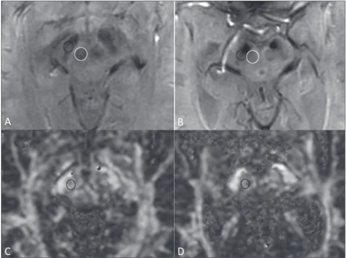 Figure 1. Findings on conventional MRI and DTI in Parkinson’s disease. On T2-weighted sequences and susceptibility-weighted imaging, the normal substantia  nigra presents as a band of hypointensity between the cerebral peduncle and the mesencephalic tegmen