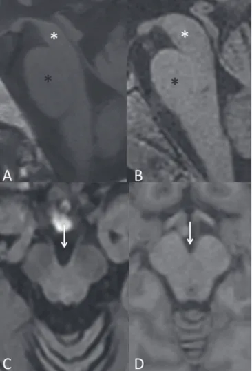 Figure 3. Morphological and signal  changes on a conventional MRI scan of  a patient with multiple system atrophy