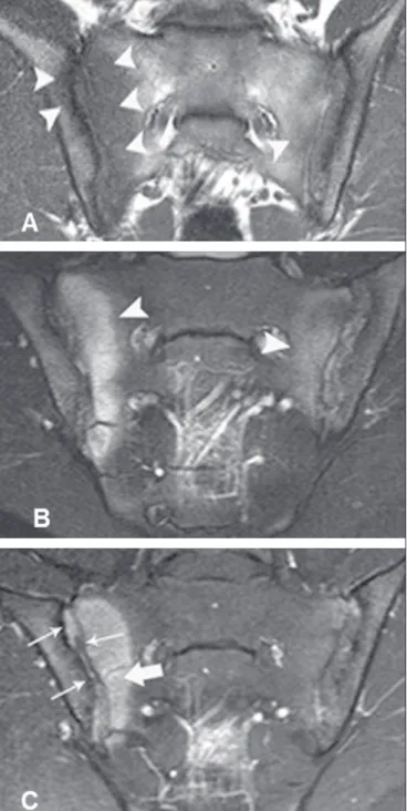 Figura 1.  Paciente masculino, 22 anos, com diagnóstico de espondiloartropa- espondiloartropa-tia soronegativa há seis anos