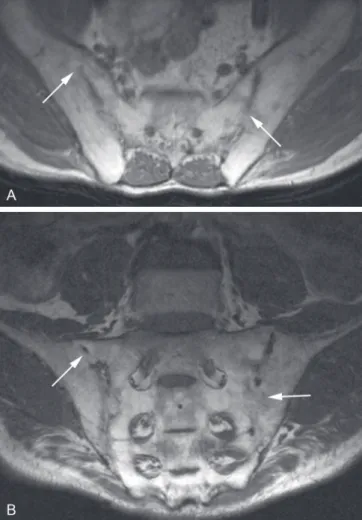 Figura 6.  Paciente masculino, 61 anos, com diagnóstico de espondiloartropa- espondiloartropa-tia soronegativa há 11 anos