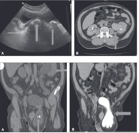 Figure 1. A: Ultrasound showing a cal- cal-culus within the bladder and another  calculus at the ureterovesical junction,  with upstream dilation of the renal  ex-cretory pathway (arrows)
