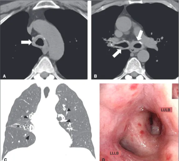 Figure 1.  A,B: Axial CT scan of the  chest (mediastinal window), without  contrast administration, at the level  of the proximal segment of the  tra-chea (A) and below the carina (B),  showing  signiicant  concentric   thick-ening of the wall and small  c