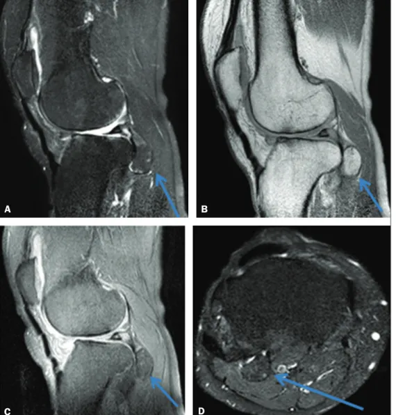 Figure 1. Non-contrast-enhanced MRI   scans. T2-weighted spectral  presatu-ration inversion recovery (SPIR)  se-quence (A) and proton-density (PD)  sequence (B), both acquired in the  sagittal plane, showing a voluminous  ossiied mass, measuring 2.2 × 1.7 