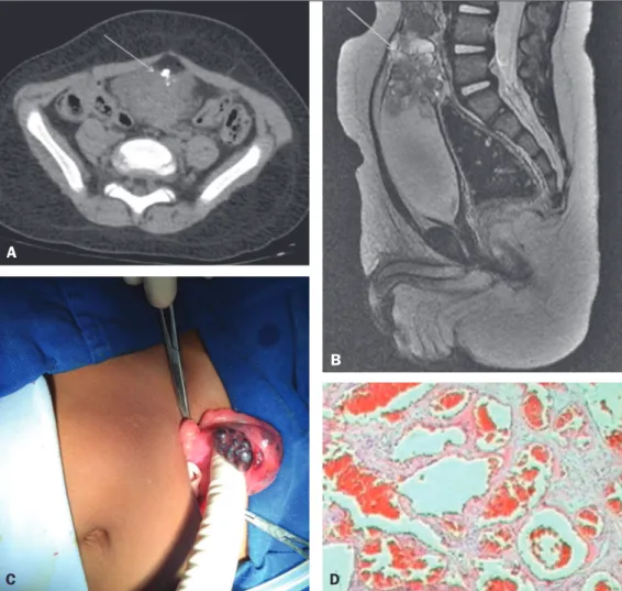 Figure 1. A: Axial computed tomog- tomog-raphy scan of the abdomen, showing  a partially delimited, solid-to-cystic  expansile urinary bladder lesion with  a vegetative component, presenting  lobulated contours, a small focal  cal-ciication,  and  enhancem