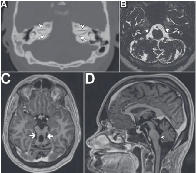 Figure 1. A: Oblique axial CT scan of the ears, with bone window settings, showing a narrow, duplicated internal auditory channel, one channel containing the  facial nerve (arrowhead) and the other containing the vestibulocochlear nerve (arrow)
