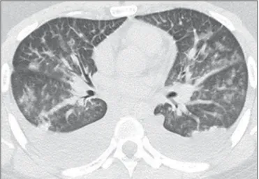 Figure 1. A 28-year-old man with fever and rapidly progressive dyspnea. High- High-resolution computed tomography with axial reconstruction shows bilateral  ground-glass opacities
