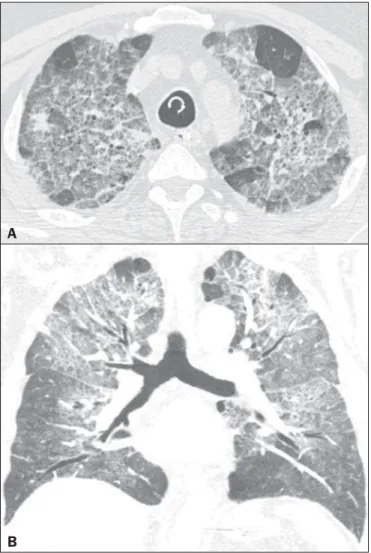 Figure 5. A 43-year-old man with dyspnea, dry cough, and fever. High-resolution computed tomography with axial (A) and coronal (B) reconstructions shows  bilat-eral areas of ground-glass opacities associated with inter- and intralobular septal thickening (