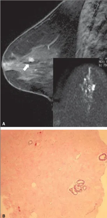 Figure 1. Contrast-enhanced sagittal T1-weighted fat-saturated MRI scan (A) showing a 0.8-cm focal enhancement considered suspicious (arrow) and its  rep-resentation on axial DWI (marked with an ROI), which displays an ADC of 1.30 × 10 –3  mm 2 /s
