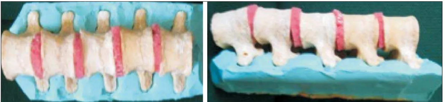 Figure 1. Spine model composed of five lumbar vertebrae placed within a silicon mold.