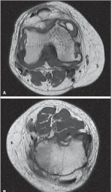 Figura 3. Mensuração por ressonância magnética. A: Fêmur distal direito – men- men-suração da largura total do fêmur